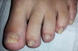 Лечение грибка ногтей и кожи на ногах в запущенной форме